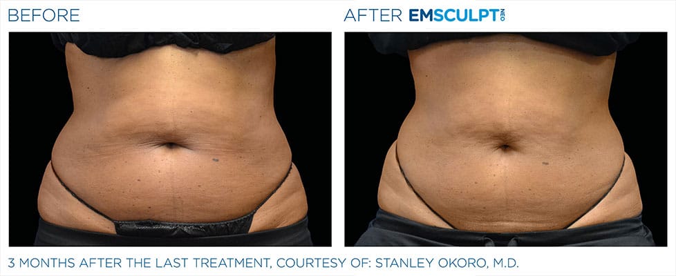 before & after results of EMSCULPT NEO in Sterling, VA