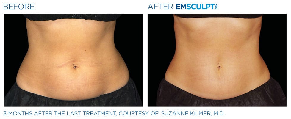 before & after stomach results of EMSCULPT NEO in Sterling, VA