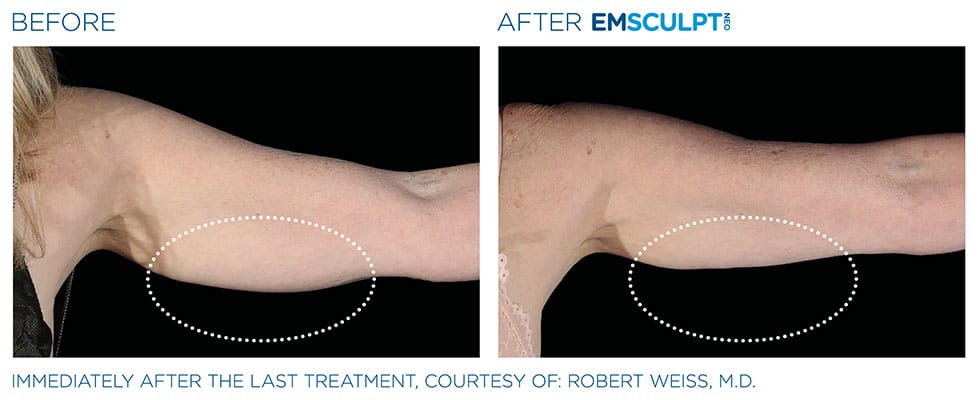 before & after under arm results of EMSCULPT NEO in Sterling, VA