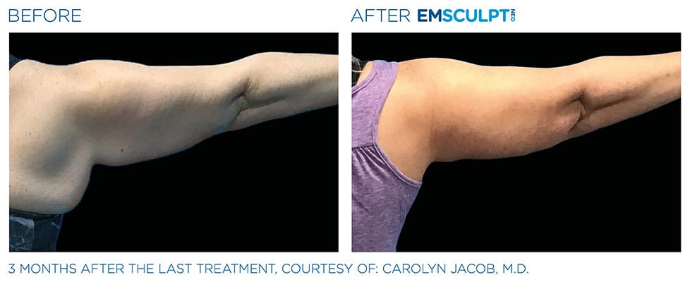 before & after arm results of EMSCULPT NEO in Sterling, VA