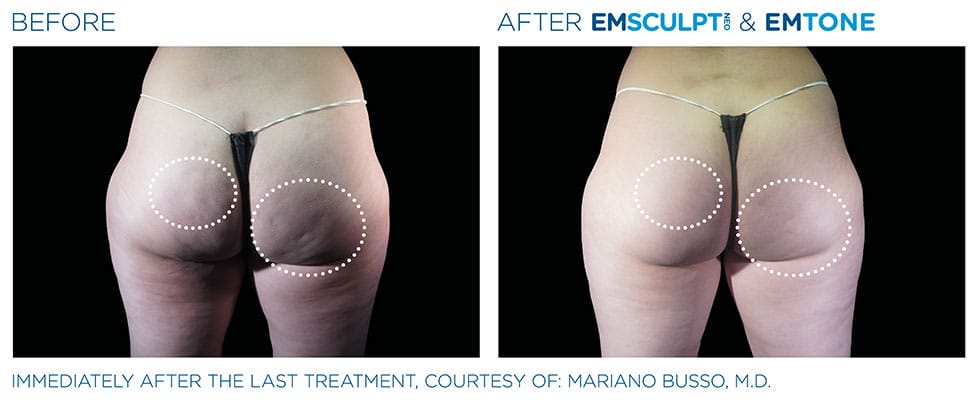 before & after buttocks results of EMSCULPT NEO in Sterling, VA