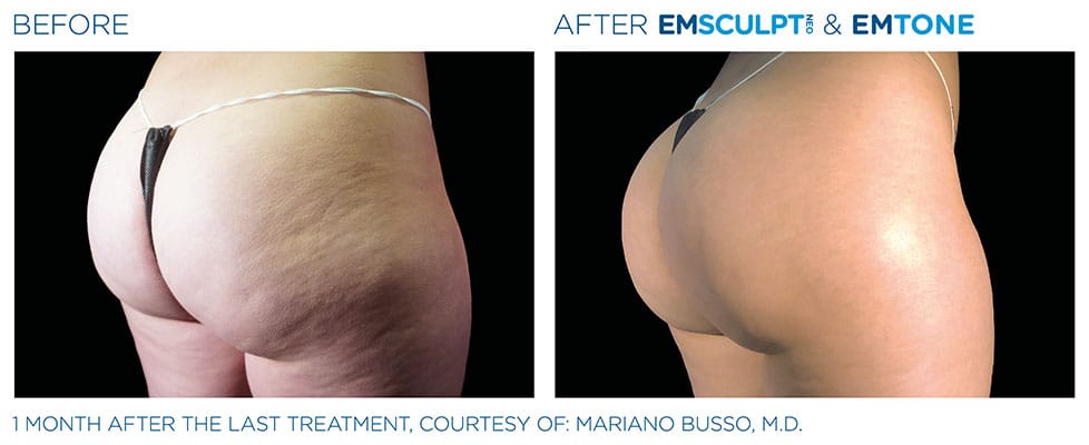 before & after buttocks results of EMSCULPT NEO in Sterling, VA