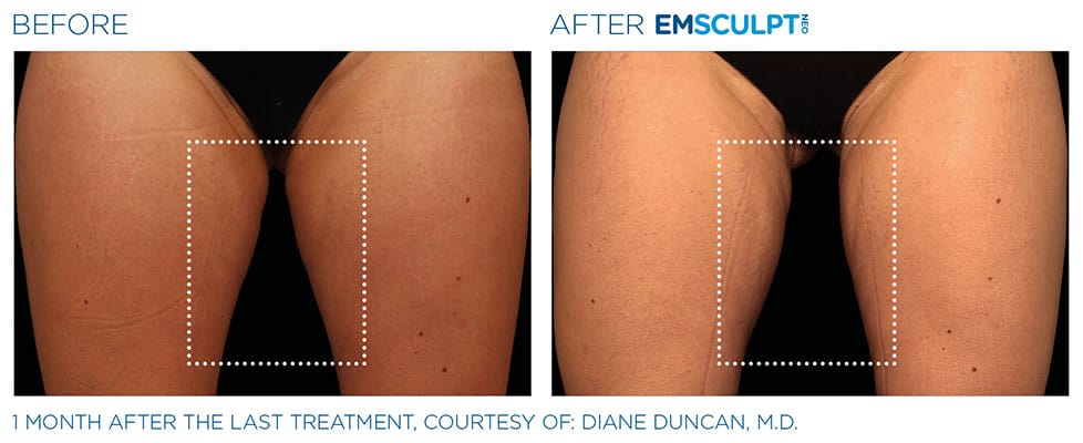 before & after thigh results of EMSCULPT NEO in Sterling, VA