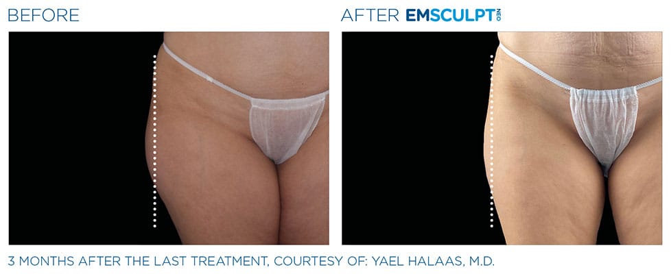 before & after results of EMSCULPT NEO in Sterling, VA
